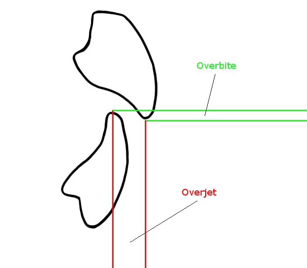 overjet overbite